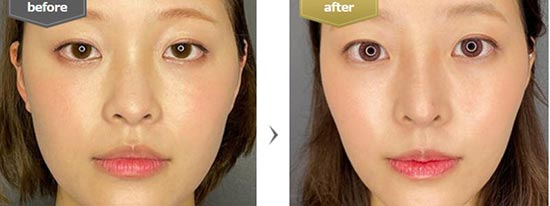 東京美容外科の鼻中隔延長、鼻尖形成、隆鼻術（プロテーゼ）の症例