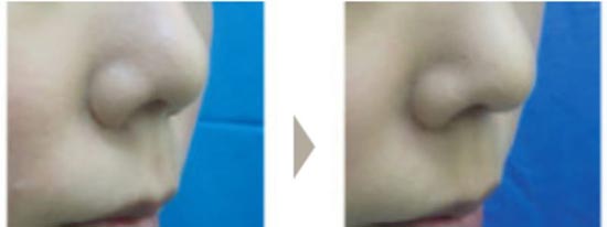 ガーデンクリニックのプロテーゼの入替・鼻尖修正・耳介軟骨移植による鼻中隔延長の症例