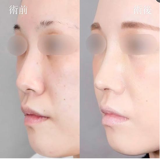 TCB東京中央美容外科の切らない鼻尖形成（3D鼻尖形成）の症例