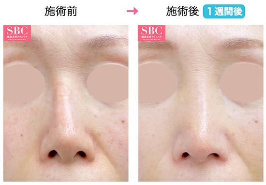 湘南美容クリニックの他院修正、鼻中隔延長術（鼻中隔軟骨）、鼻尖形成術3D法
の症例