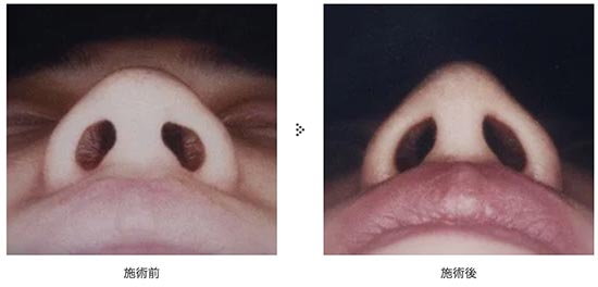 共立美容外科のだんご鼻(鼻尖形成)
の症例