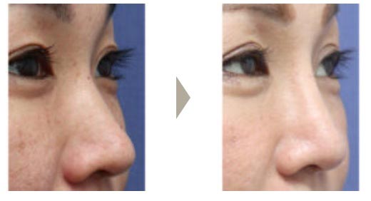 ガーデンクリニックの鼻のプロテーゼ・耳介軟骨移植・小鼻縮小の症例
