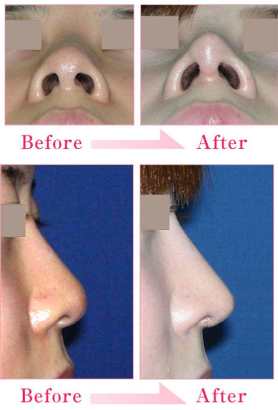 城本クリニックの鼻尖縮小術（鼻尖形成術）の症例
