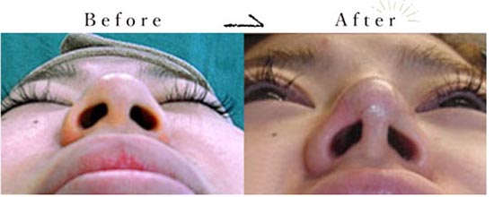 クリニークのプチクイック鼻尖[内側法]の症例