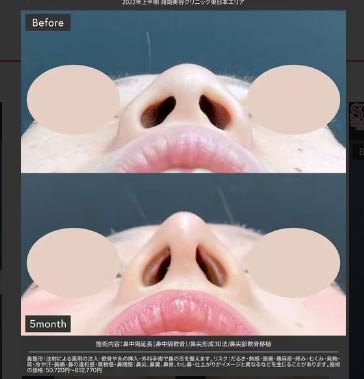 湘南美容クリニックの鼻尖形成の症例