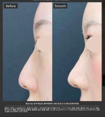 湘南美容クリニックの鼻尖形成の症例