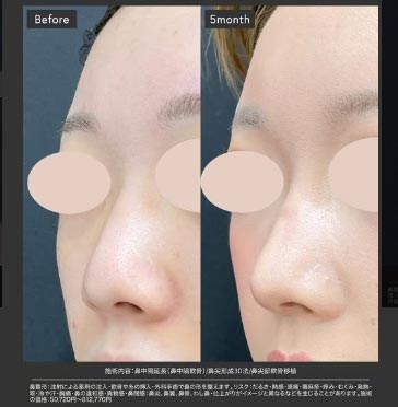湘南美容クリニックの鼻尖形成								の症例