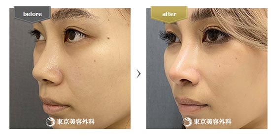 東京美容外科の鼻尖形成の症例