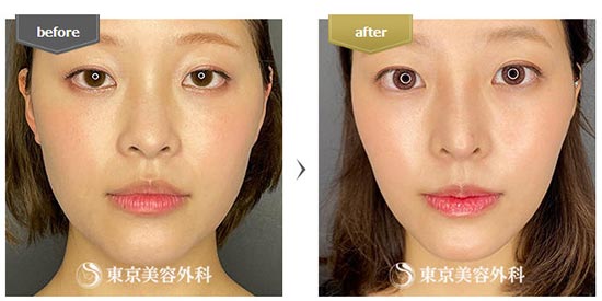 東京美容外科の鼻尖形成の症例