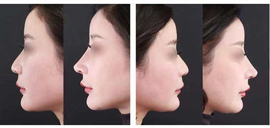 TAクリニックの鼻尖形成の症例