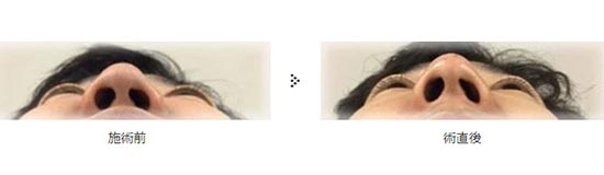 共立美容外科の鼻尖形成の症例