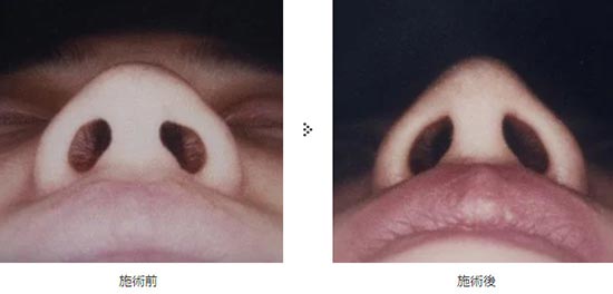 共立美容外科の鼻尖形成の症例