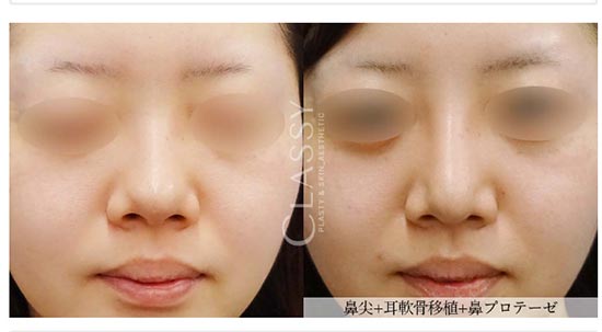 CLASSY 仙台美容外科・美容皮膚科の鼻尖形成の症例