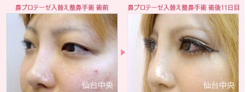 仙台中央クリニックの鼻尖形成の症例