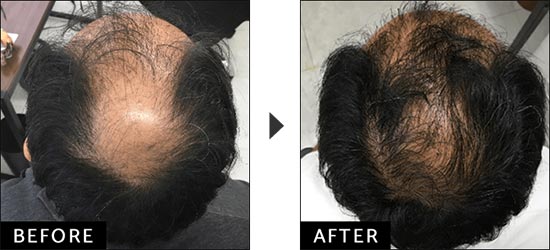 ウィルAGAクリニックの発毛トータルエクストラコースで内服薬+最新LHDV頭皮注入治療の症例