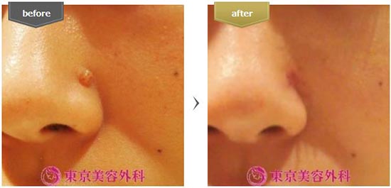 東京美容外科のイボ除去の症例