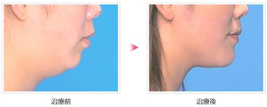 青山セレスクリニックの頬・顎の脂肪吸引の症例