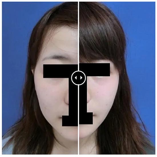 グローバルビューティークリニックのGBC精密脂肪吸引（ほほ・顎下）＋ 秘密の美肌小顔リフトの症例