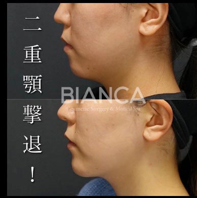 ビアンカクリニックのベイザー脂肪吸引(顎下)の症例