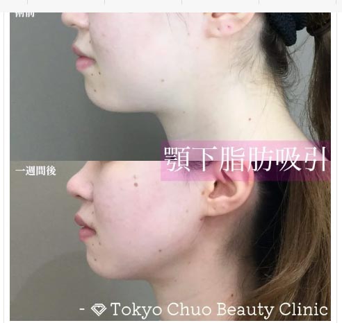 TCB東京中央美容外科の顔の脂肪吸引(大阪)の症例