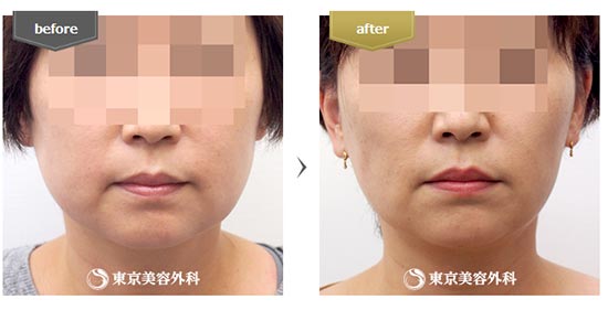 東京美容外科の顔の脂肪吸引(大阪)の症例