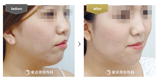 東京美容外科の顔の脂肪吸引(大阪)の症例