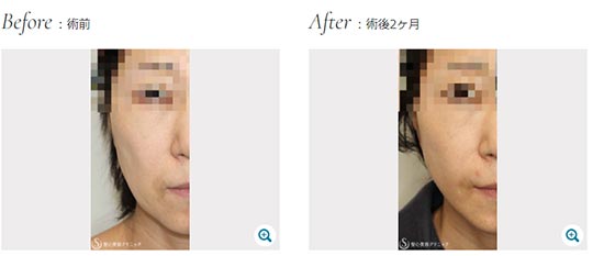 聖心美容クリニックの顔の脂肪吸引(大阪)の症例