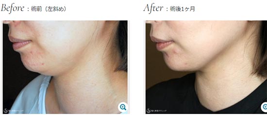 聖心美容クリニックの顔の脂肪吸引(大阪)の症例