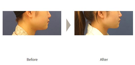 ガーデンクリニックの顔の脂肪吸引(大阪)の症例