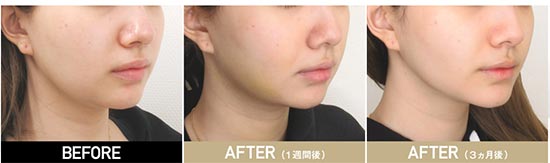 TAクリニックの顔の脂肪吸引(大阪)の症例