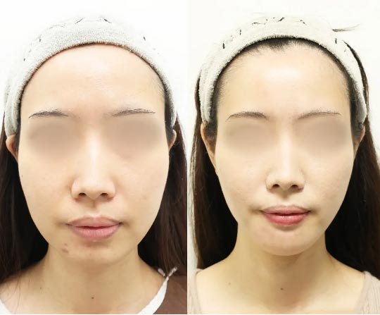 TAクリニックの顔の脂肪吸引(大阪)の症例