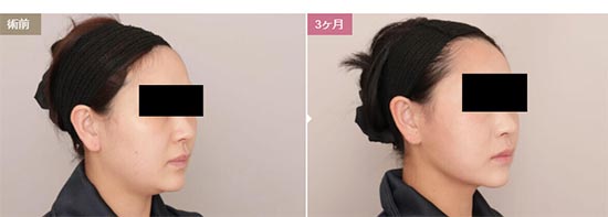 モッズクリニックの顔の脂肪吸引(大阪)の症例