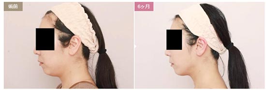 モッズクリニックの顔の脂肪吸引(大阪)の症例