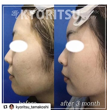 共立美容外科の顔の脂肪吸引(大阪)の症例