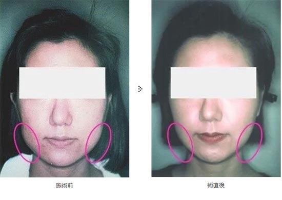 共立美容外科の顔の脂肪吸引(大阪)の症例