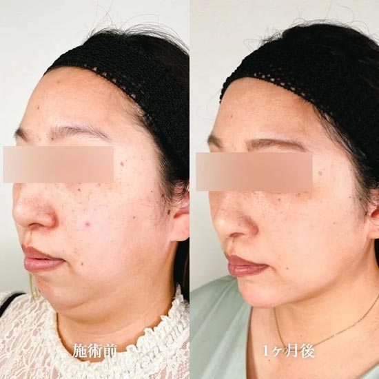 TCB東京中央美容外科のTCB式小顔脂肪吸引の症例