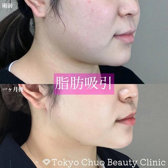 TCB東京中央美容外科のTCB式小顔脂肪吸引の症例
