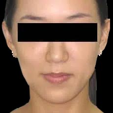 渋谷美容外科クリニックの頬・あご裏脂肪吸引の症例