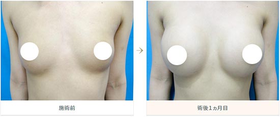 水の森美容クリニックの乳腺下法（シリコン250cc）の症例
