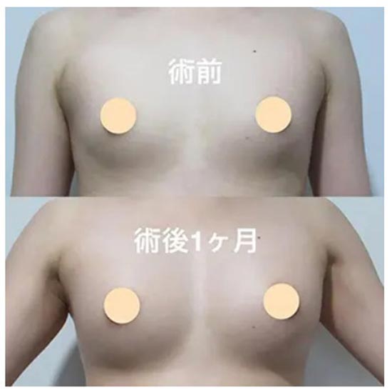 共立美容外科のコンデンスリッチ豊胸術の症例