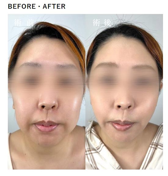 TCB東京中央美容外科の顔の脂肪吸引の症例