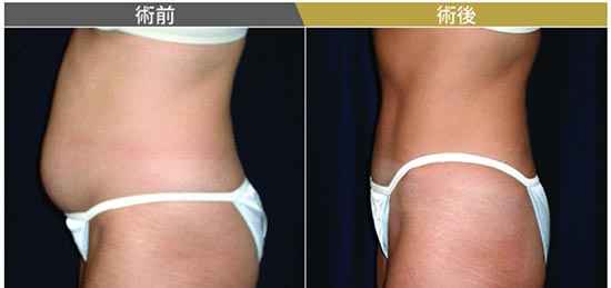 東京美容外科のベイザー脂肪吸引の症例