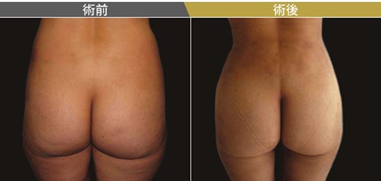 東京美容外科のベイザー脂肪吸引の症例