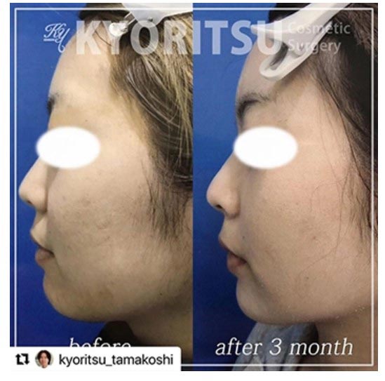 共立美容外科の顔の脂肪吸引の症例
