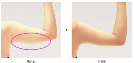 共立美容外科の二の腕の脂肪吸引の症例