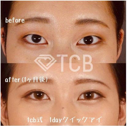 TCB東京中央美容外科の1dayクイックアイ プレミアムエタニティの症例