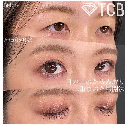 TCB東京中央美容外科の二重埋没法の症例