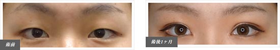 TCB東京中央美容外科の二重まぶた整形：切開法の症例