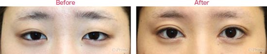 プリモ麻布十番クリニックのED 全切開＋上眼瞼脱脂術＋ROOF切除術＋目頭切開の症例