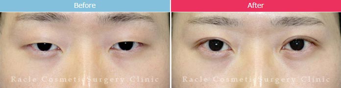 新宿ラクル美容外科クリニックの全切開法二重術＋目の上の脂肪取り(マイクロカット法)の症例